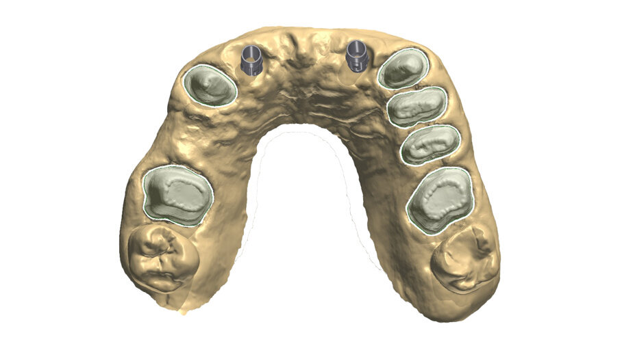 Fig. 31_L’impronta definitiva consente di rilevare in una sola seduta gli entrambe le arcate, gli elementi naturali, la posizione degli impianti, i provvisori in posizione centrica.