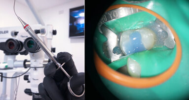 Direct pulp capping as a conservative procedure to maintain pulp vitality