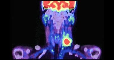 Нов трейсър помага да се избегне шийната дисекция при пациенти с рак в лицево-челюстната област