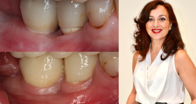 Nessun segno di perimplantite intorno ad un sistema implantare a due componenti: ulteriori evidenze a lungo termine