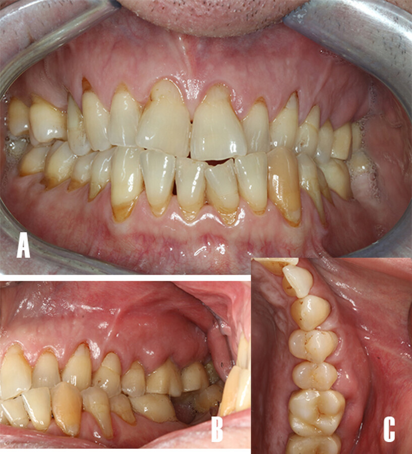 Figura 1. FotografÃ­a intraoral. A) Vista frontal: nÃ³tese las recesiones gingivales generalizadas y restauraciones con resina en cervical de los dientes. B) Imagen lateral: nÃ³tese la zona tumefacta a nivel de 26 y 27. C) Vista oclusal: se observa el absceso periodontal tumefacto extendiÃ©ndose de distal 25 a media 27.