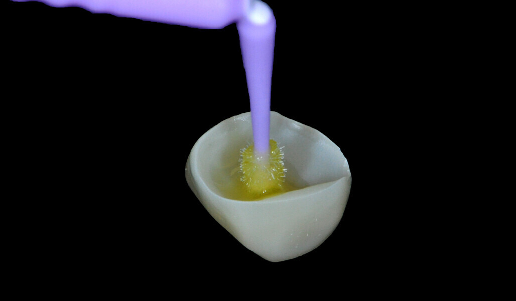 Fig. 19: Application of the universal adhesive to the overlay. 