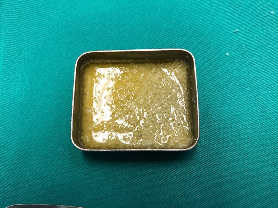 Fig. 10 - I-PRF coagulato addizionato a xenoinnesto bovino.