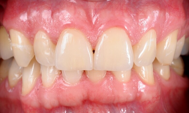 Fig. 27 One year post-op.