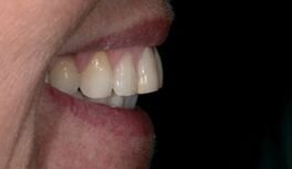 Afbeelding 1-4: Mondfoto’s en intraorale scans. In een eerste bezoek werd de wens met de patiënt besproken en werd er een aantal mondfoto’s gemaakt.