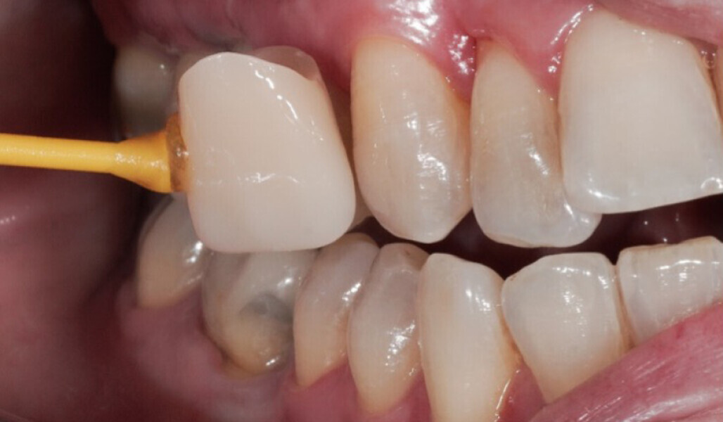 Fig. 4: Shade determination using a custom-made KATANA Zirconia STML colour sample (Shade A3.5). 