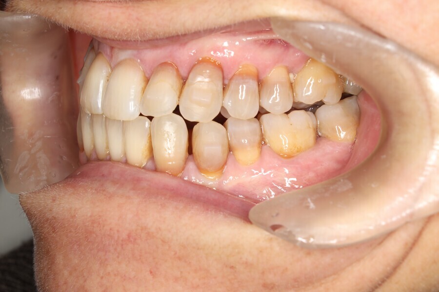 Fig. 38: Intermediate stage of Reveal aligners. Aligner #32.
