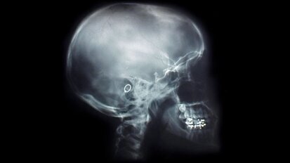 Unikatowa technologia modyfikacji implantów kostnych