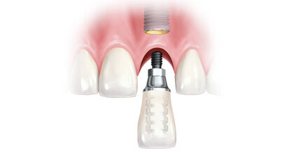 Okamžité zatížení: Co znamená pro pacienta a zubní ordinaci?