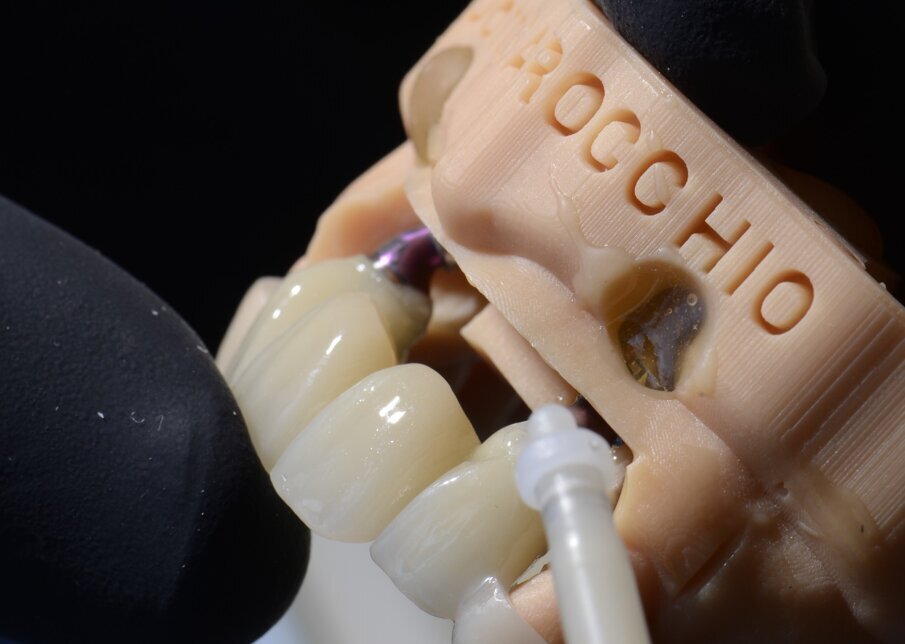 Fig. 53 - Resina per bloccare i variobase al provvisorio.