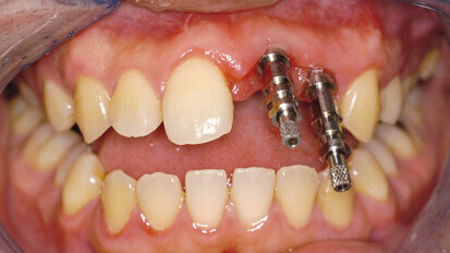Die Implantatabformung – drei Techniken im Überblick