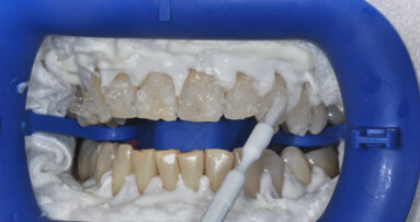 Sbiancamento professionale alla poltrona e combinato: case series