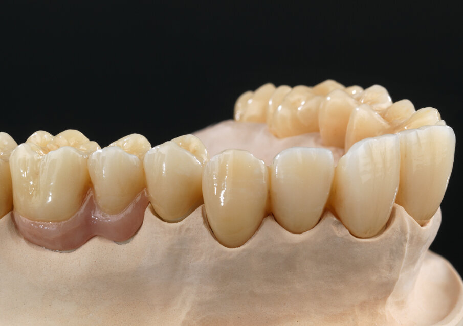 Hier abgebildet ist eine Arbeitskombination aus Zolid HT+ White und Zolid FX ML, letzteres kam 2018 auf den Markt. © Benni Votteler/Dentaltechnik Votteler