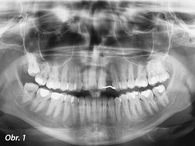 Panoramatický RTG snímek. Všimněte si úzkého prostoru v místě zubu 22.