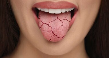 Neues Material zur Linderung bei Mundtrockenheit