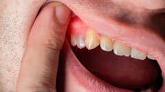 Wearable oral biosensor detects inflammation in real time