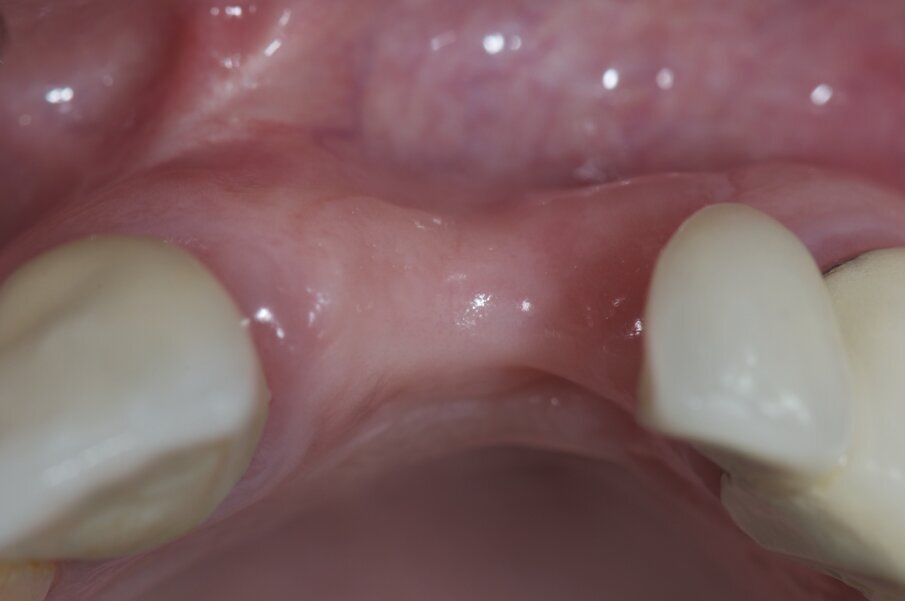 Fig. 5 - Situazione iniziale, visione occlusale..