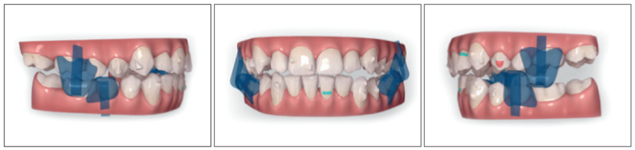 Treatment plan: How the precision wings (in blue) appear in the ClinCheck set-up.