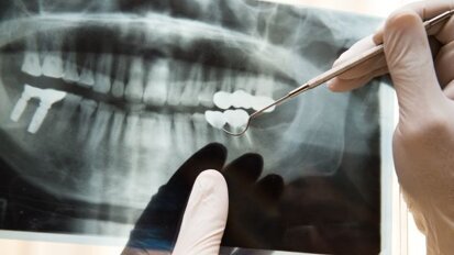 Mondzorg strenger gecontroleerd op regels röntgenfoto’s