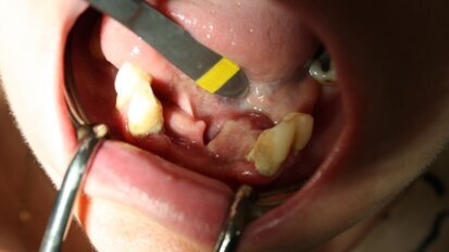 Obwodowy ziarniniak olbrzymiokomórkowy – charakterystyka i opis przypadków