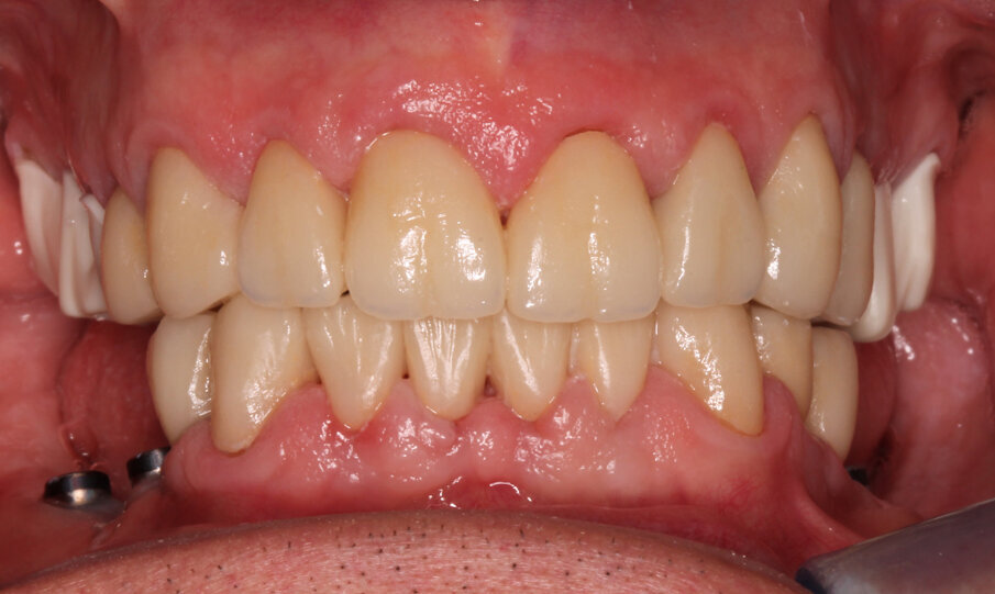 Fig. 22:Try-in of the framework prior to finalization