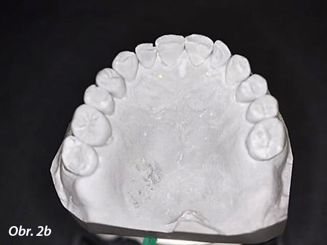 Obr. 2a, b: Sádrové modely dostupné z předešlé návštěvy