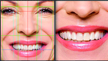 Aesthetic Digital Smile Design: Software-aided aesthetic dentistry—Part II