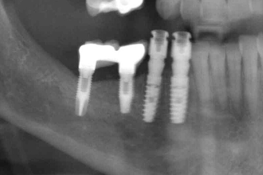 Figs. 10. Colocación de 2 implantes post-extracción en posiciones del 43 y 44 y control radiográfico post-extracción.