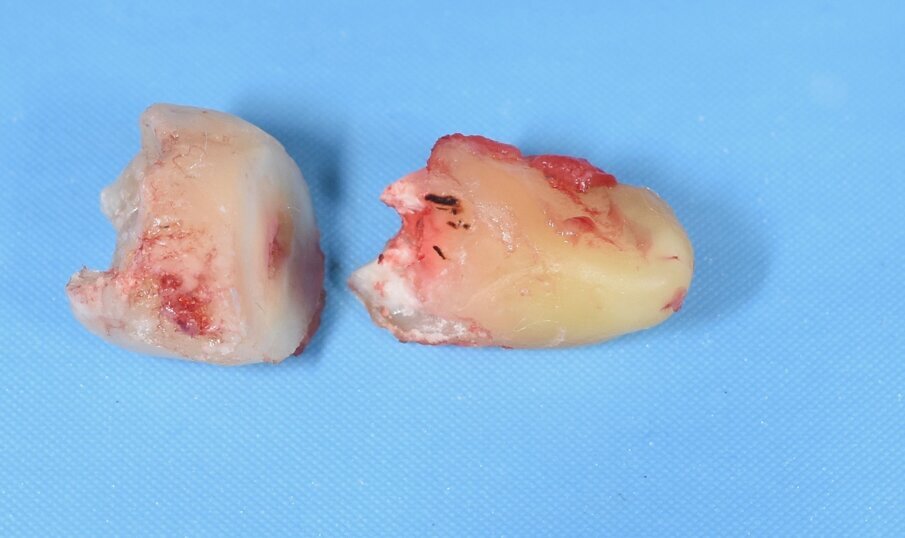 Fig. 11 - Dente estratto.