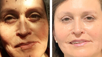 Armonización y rejuvenecimiento facial