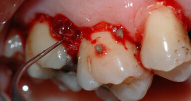 Protocolli  di trattamento parodontale non chirurgico