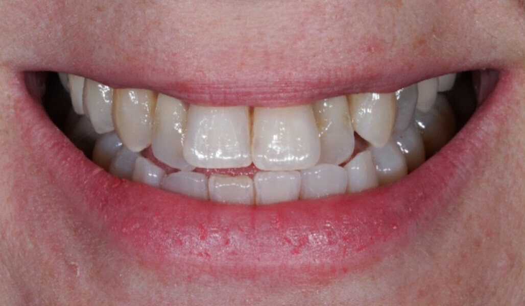 Fig. 12: Final situation. 