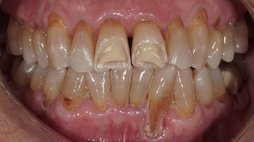 Fig. 2: Clinical situation at the initial appointment in the dental practice.