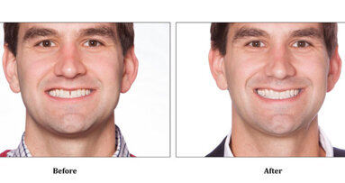 Company offers patients ‘do-it-at-home’ orthodontics