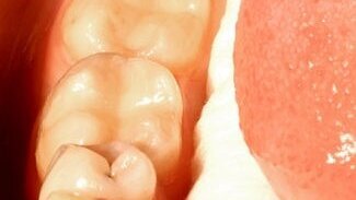 BPA може да се отделя чрез слюнката и урината след поставяне на композитна обтурация