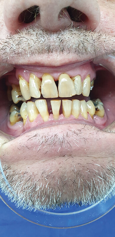 Sl. 2.5: Pacijent B, kontrola nakon 2 meseca od potpunog prestanka pušenja