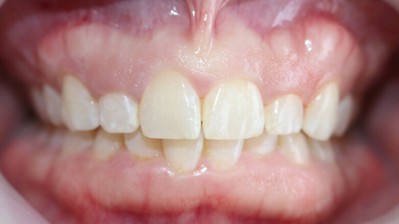 Aesthetic crown lengthening, exostosis removal and veneer restorations