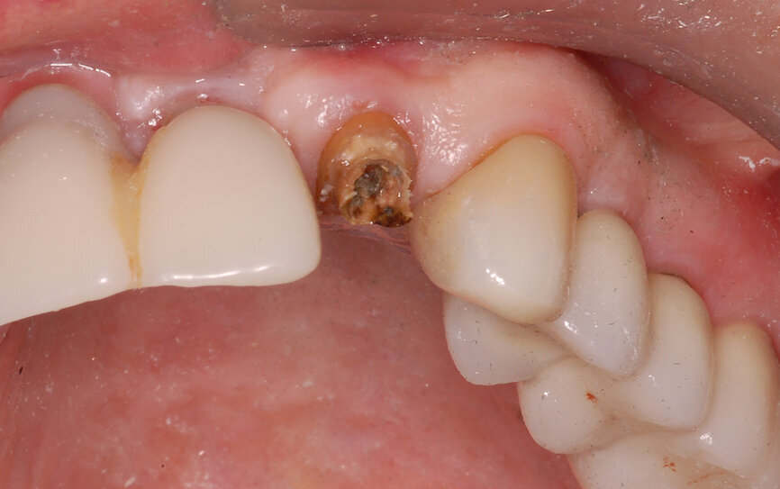 Fig. 1: The patient presented with a horizontally fractured clinical crown, an indication for a partial extraction therapy procedure.