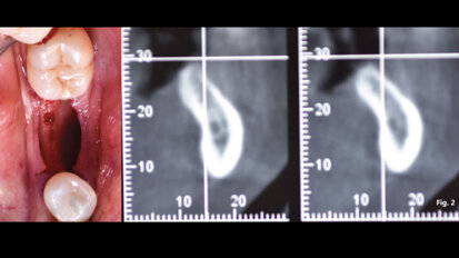 Risoluzione di una atrofia orizzontale