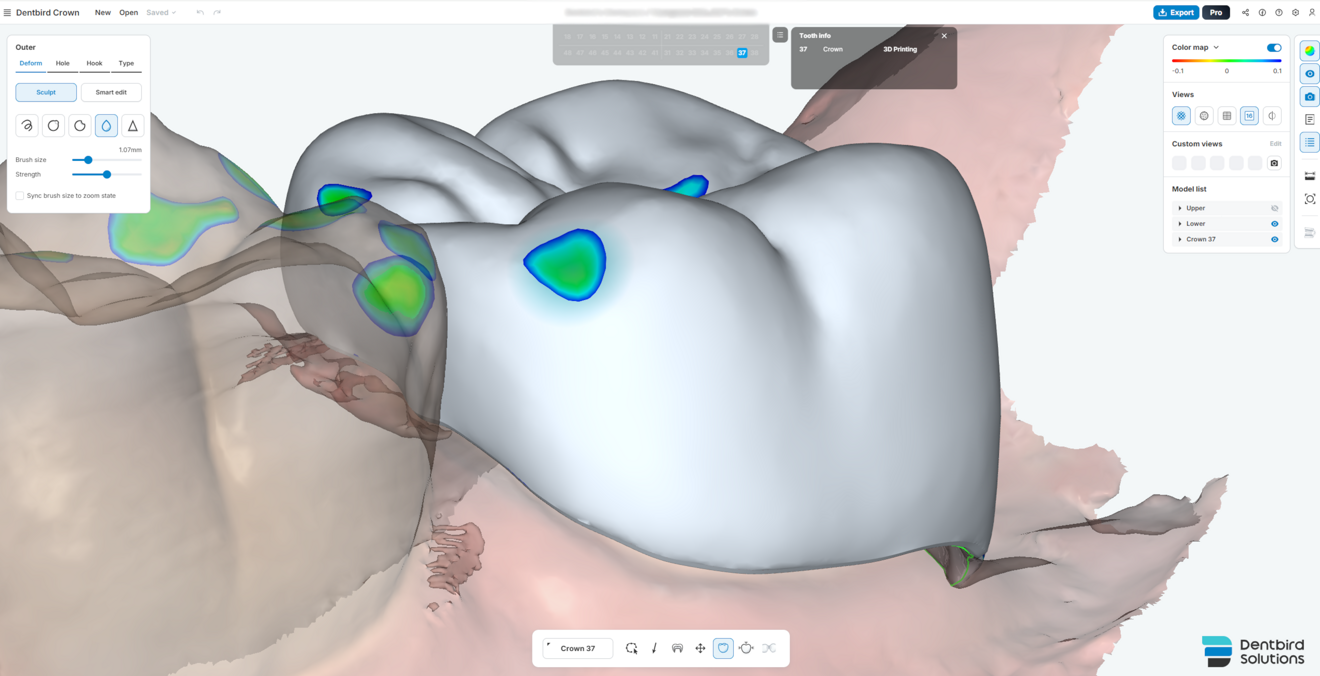 Fig. 6a: Results after selective manual adjustments to the crown’s contact surfaces and occlusal contact distribution.
