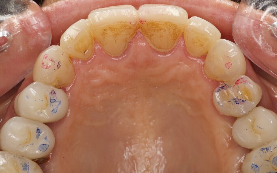 Fig. 14c: Occlusal view.