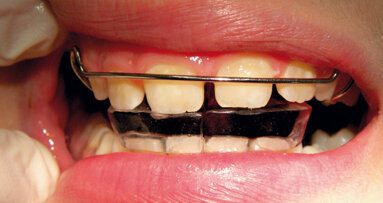 Ugroženo zdravlje pacijenata sa protezom usled povećanog broja mikroba