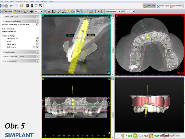 Tvoření chirurgické šablony na základě naplánované pozice implantátu v programu SIMPLANT.