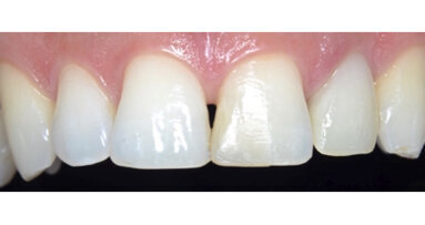 Resinas Compuestas: Estado Actual