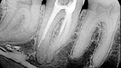 Fig. 3: Calcium hydroxide extruded into the mandibular canal through a perforation.