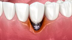 Particules de titane associées à l’échec des antibiotiques dans la péri-implantite