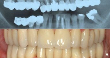 Експерт обяснява напредъка в имплантологията с помощта на дигиталните технологии