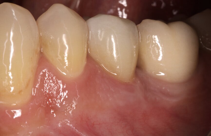 Fig. 13: Clinical situation two years after treatment.