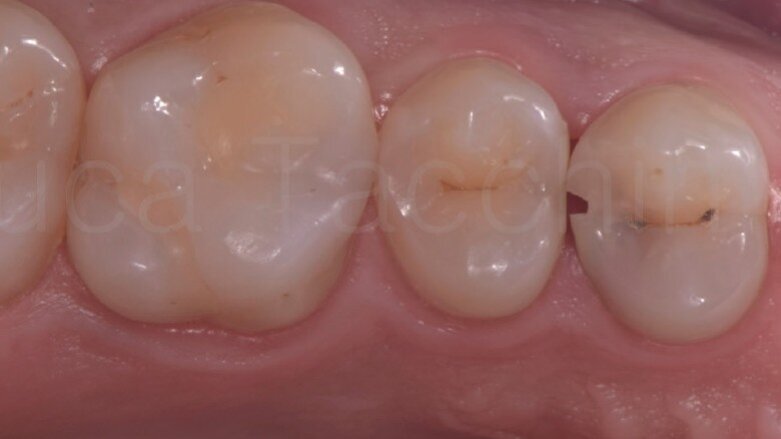 La gestione del punto di contatto nelle II classi