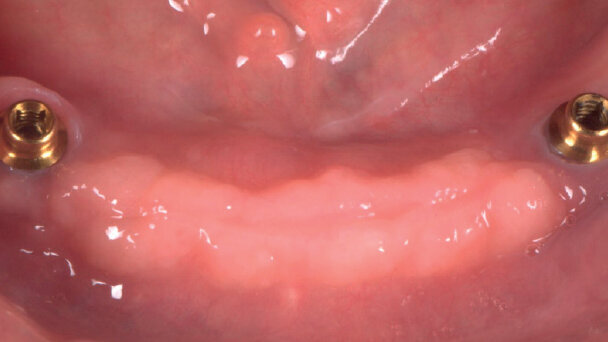 Riabilitazione superiore a supporto osteo-mucoso contrapposta a overdenture ritenuta e sostenuta da impianti